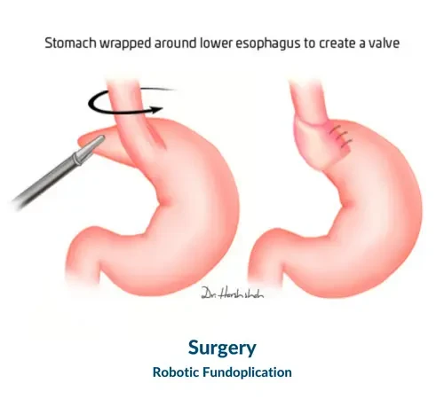 Robotic Fundoplication Surgery 1