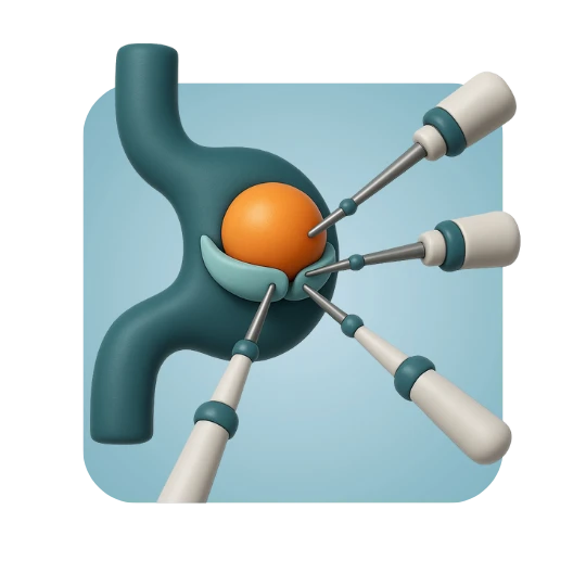 Robotic Hiatal Hernia Repair (If Hiatal Hernia is Present)