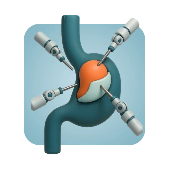 Robotic Partial Fundoplication (Tailored Approach)