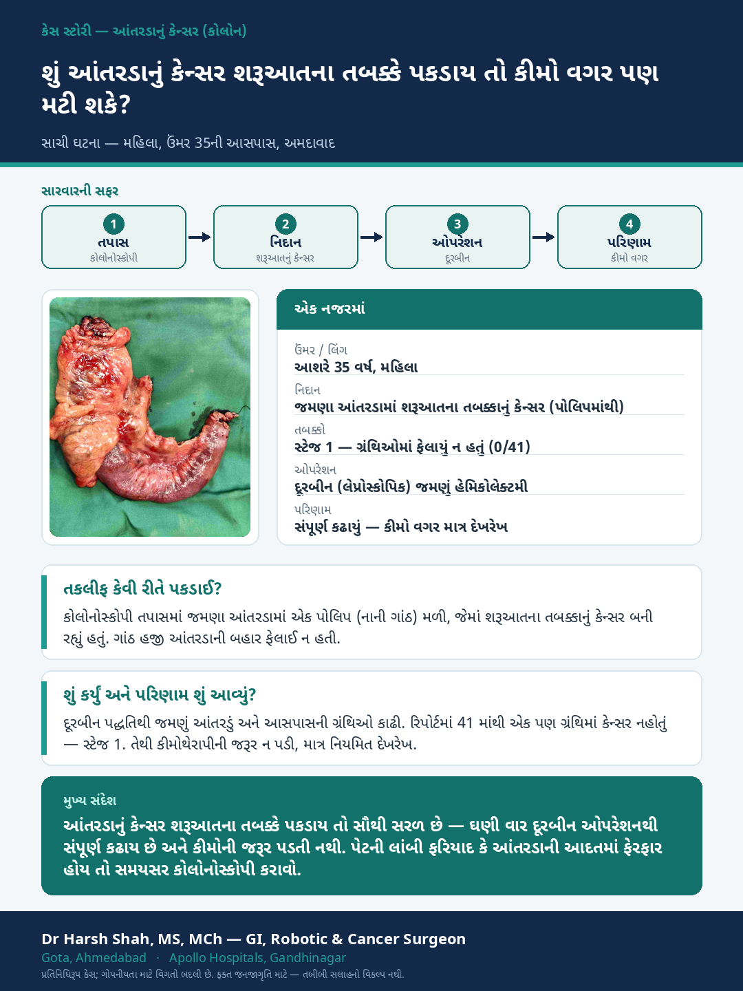 Colon Cancer patient case — Early colon cancer caught on colonoscopy — removed without chemo. Dr Harsh Shah, GI & cancer surgeon, Ahmedabad.