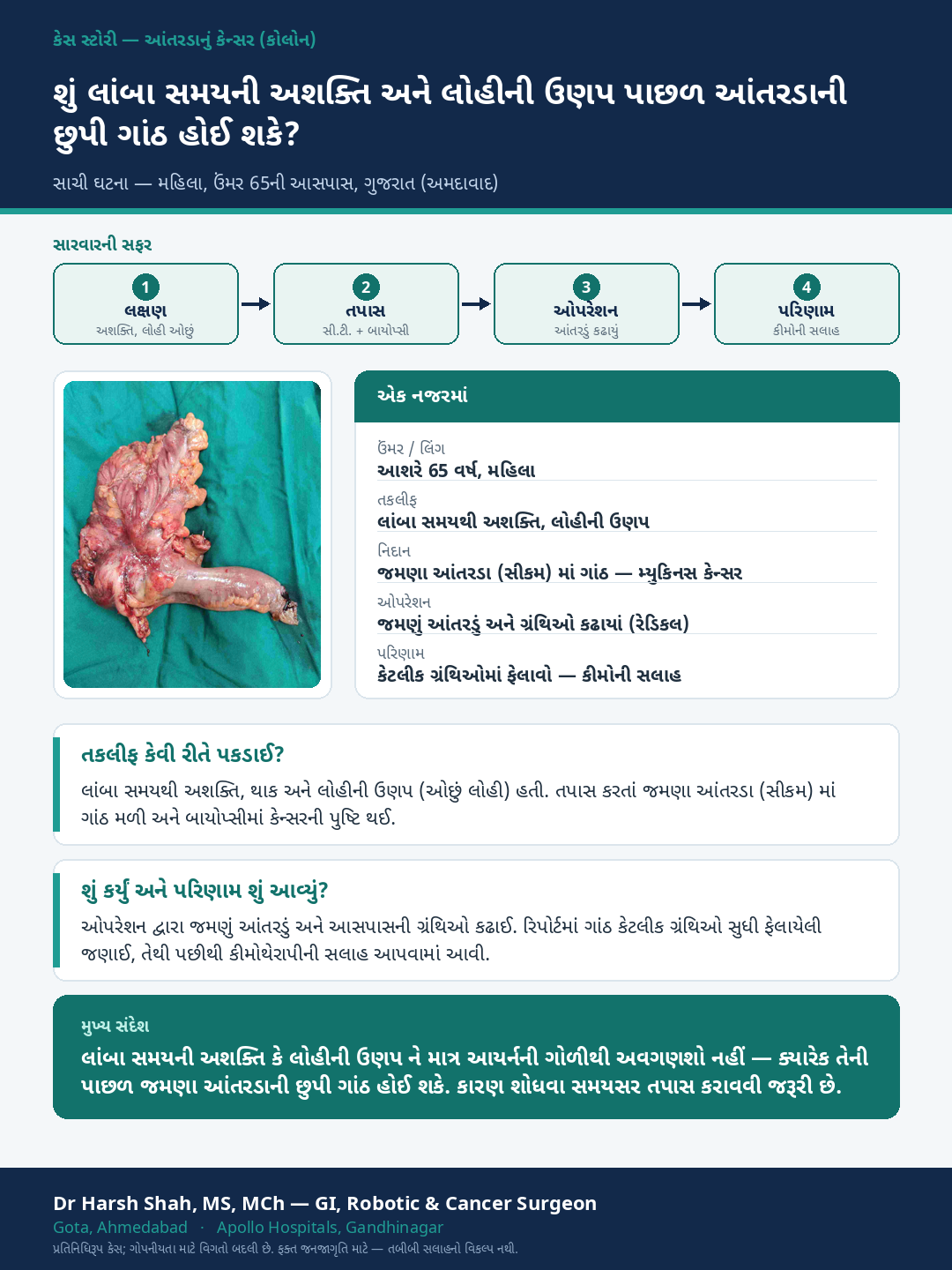 Colon Cancer patient case — Long-standing anaemia hiding a right-colon cancer. Dr Harsh Shah, GI & cancer surgeon, Ahmedabad.
