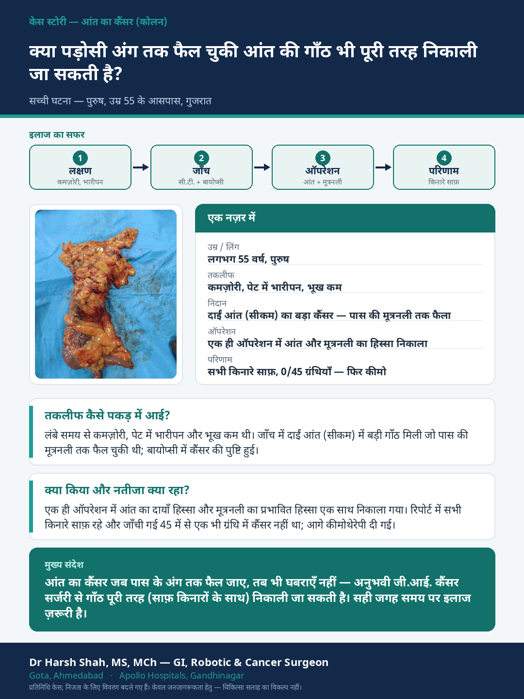 Colon Cancer patient case — A colon cancer grown into a neighbouring organ — completely removed. Dr Harsh Shah, GI & cancer surgeon, Ahmedabad.