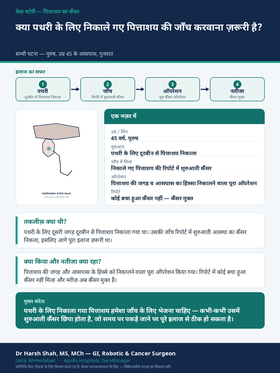 Gallbladder Cancer patient case — Early cancer found in a gallbladder removed for stones — why biopsy matters. Dr Harsh Shah, GI & cancer surgeon, Ahmedabad.