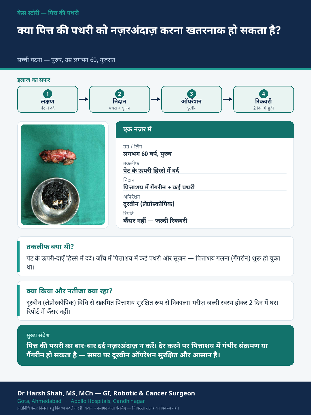 Gallstones patient case — Why leaving old gallstones untreated can be dangerous. Dr Harsh Shah, GI & cancer surgeon, Ahmedabad.