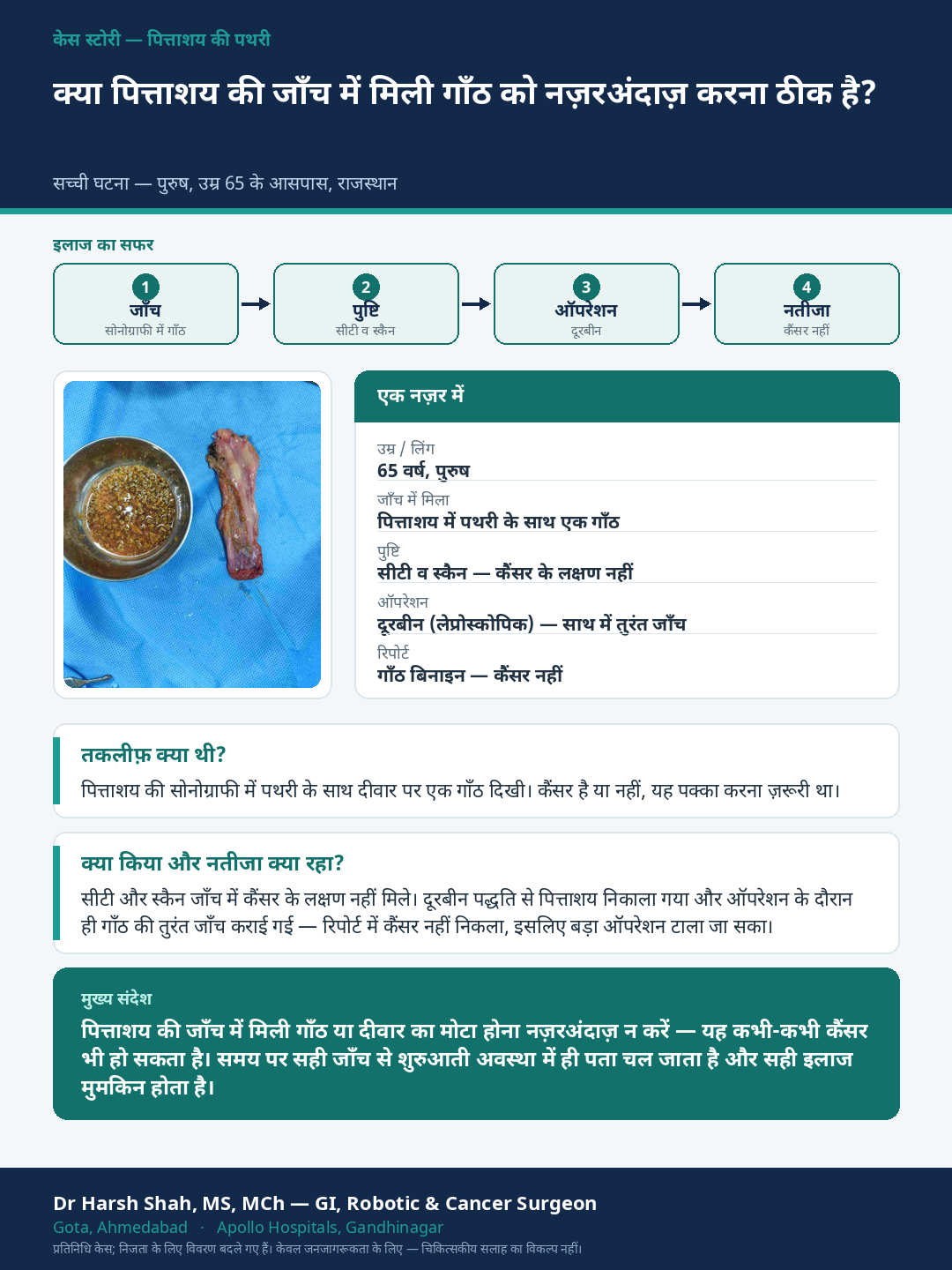 Gallstones patient case — A lump found in the gallbladder wall — investigated, not ignored. Dr Harsh Shah, GI & cancer surgeon, Ahmedabad.