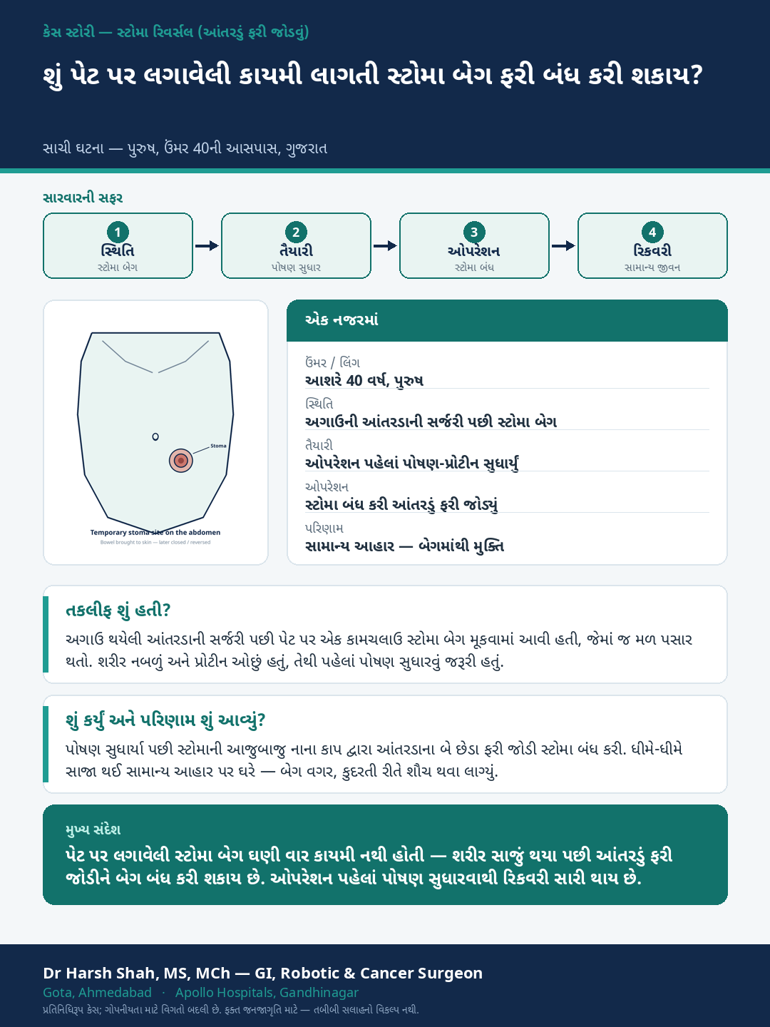 General GI Surgery patient case — A temporary stoma bag — reversed and closed. Dr Harsh Shah, GI & cancer surgeon, Ahmedabad.