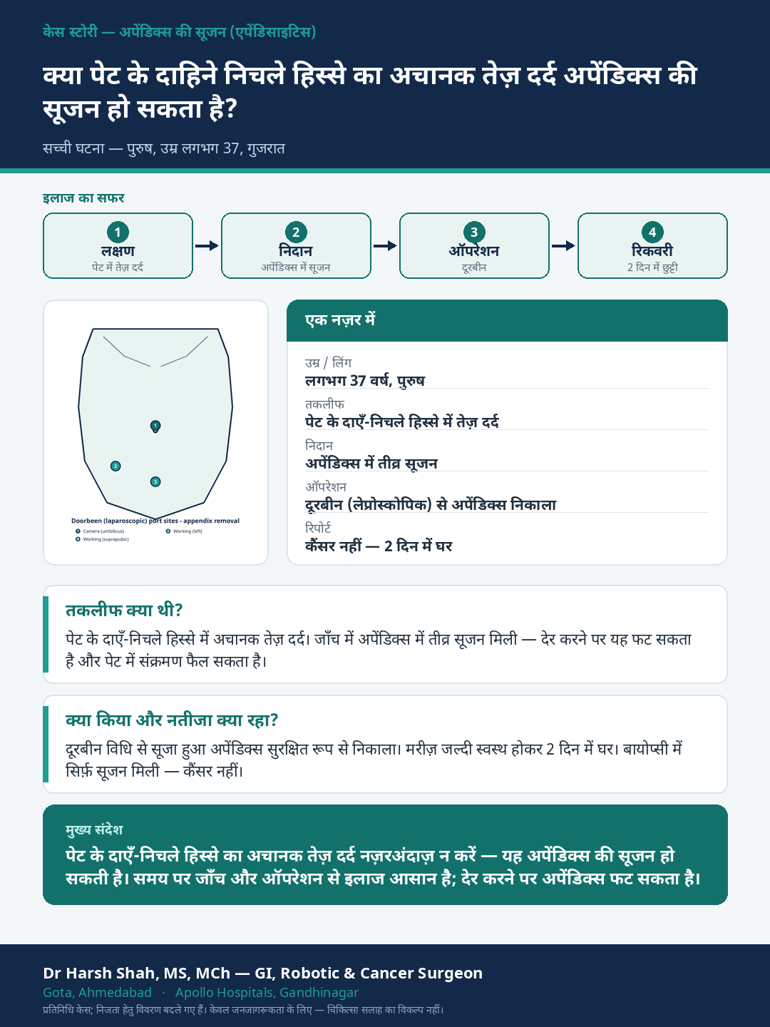 General GI Surgery patient case — Sudden right-lower abdominal pain — acute appendicitis. Dr Harsh Shah, GI & cancer surgeon, Ahmedabad.