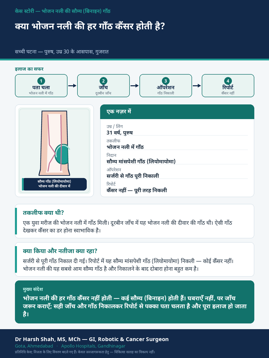 GERD & Swallowing Disorders patient case — A growth in the food pipe that turned out to be benign. Dr Harsh Shah, GI & cancer surgeon, Ahmedabad.