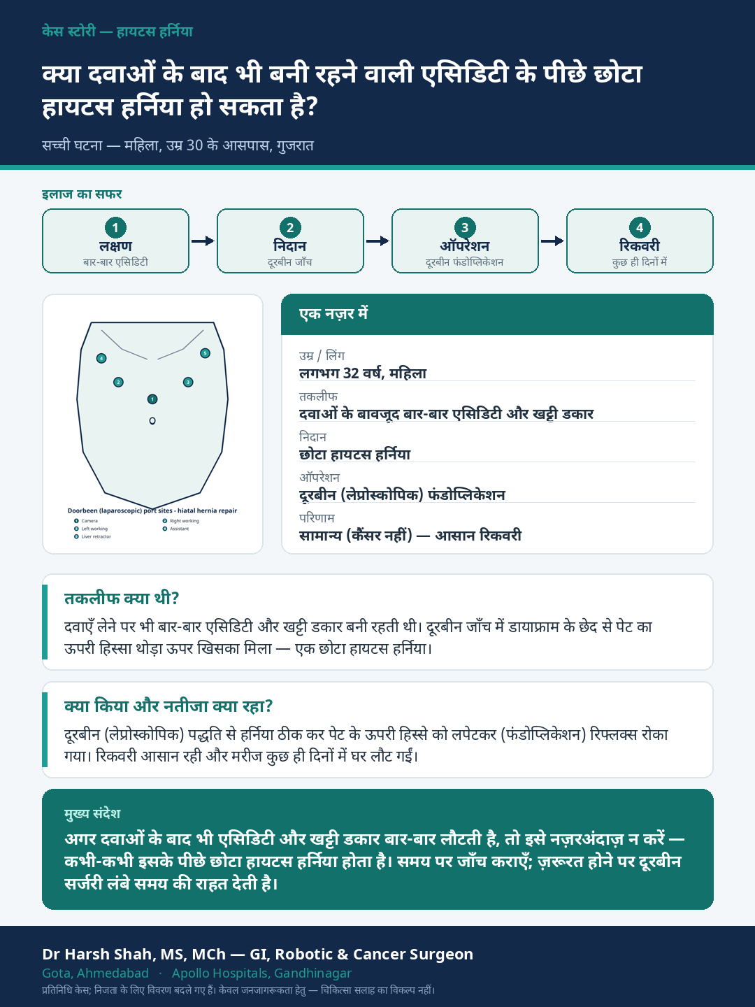 Hernia (Hiatal) patient case — Acidity not controlled by medicines — a small hiatal hernia found. Dr Harsh Shah, GI & cancer surgeon, Ahmedabad.