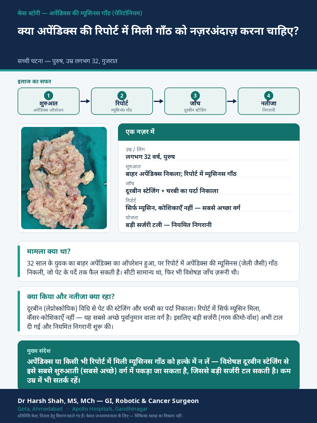Peritoneal Surface Cancer & HIPEC patient case — An appendix tumour caught early. Dr Harsh Shah, GI & cancer surgeon, Ahmedabad.