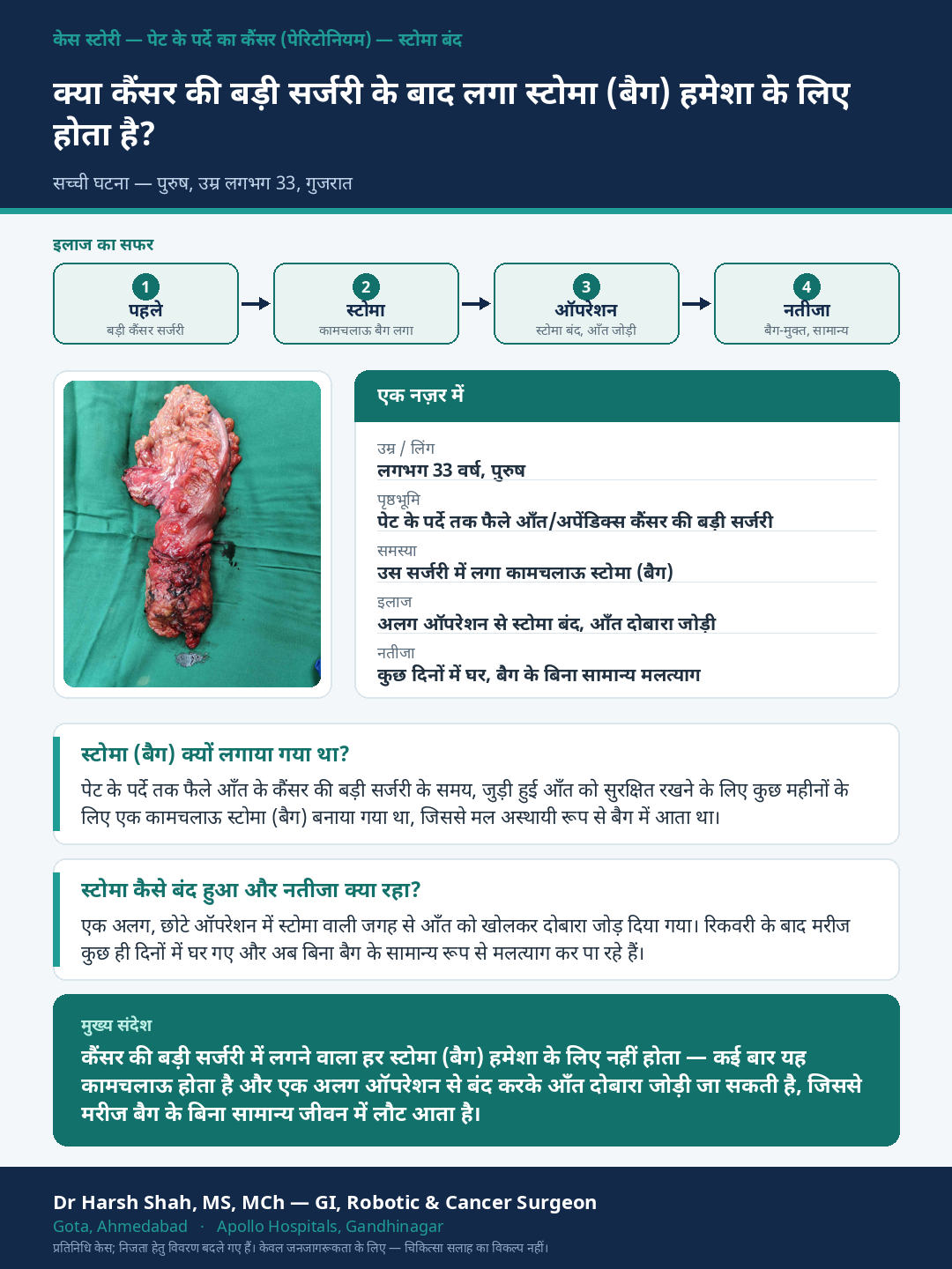 Peritoneal Surface Cancer & HIPEC patient case — A temporary stoma after major surgery — later reversed. Dr Harsh Shah, GI & cancer surgeon, Ahmedabad.
