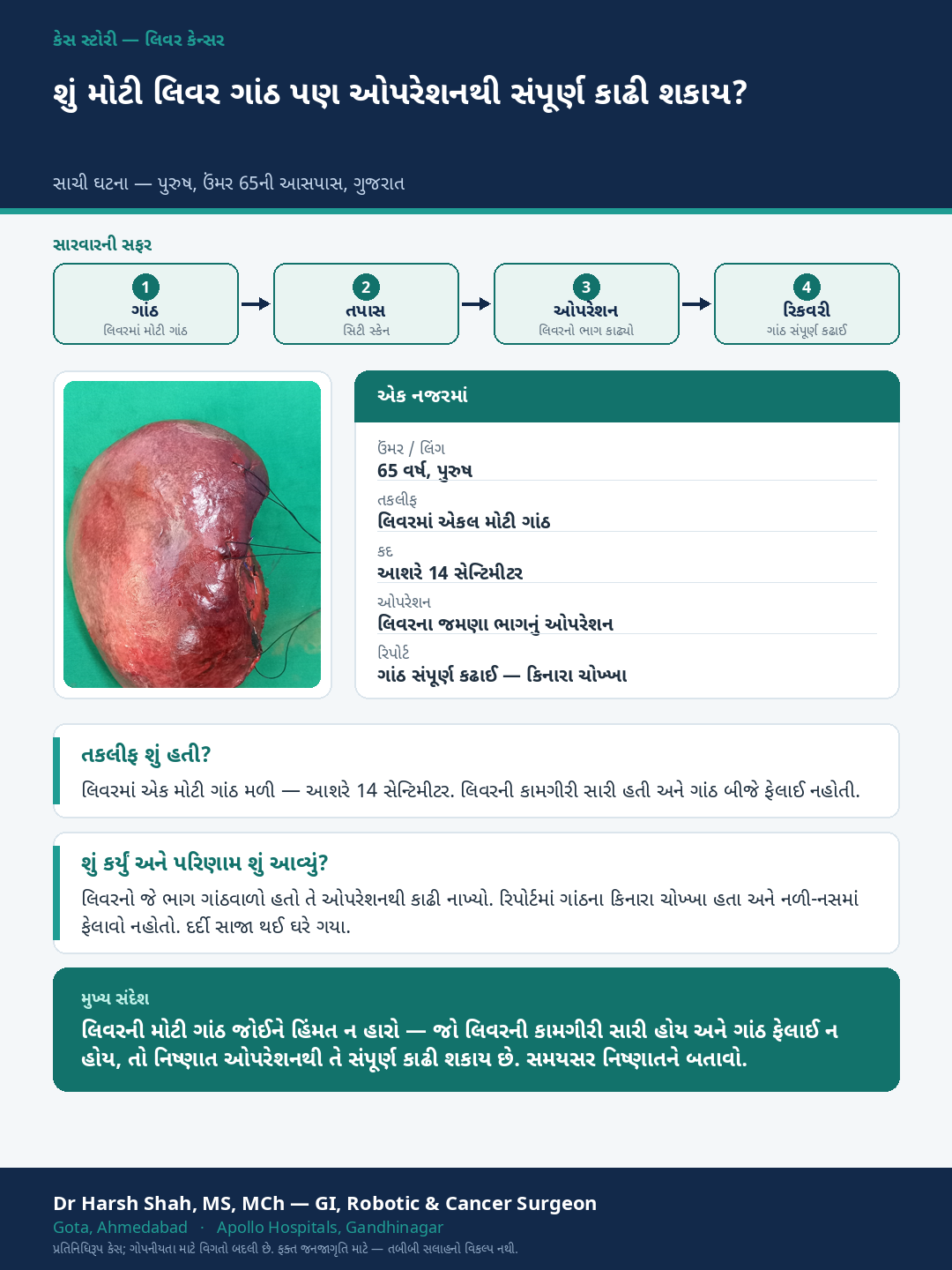 Liver Cancer patient case — A large liver tumour removed completely. Dr Harsh Shah, GI & cancer surgeon, Ahmedabad.