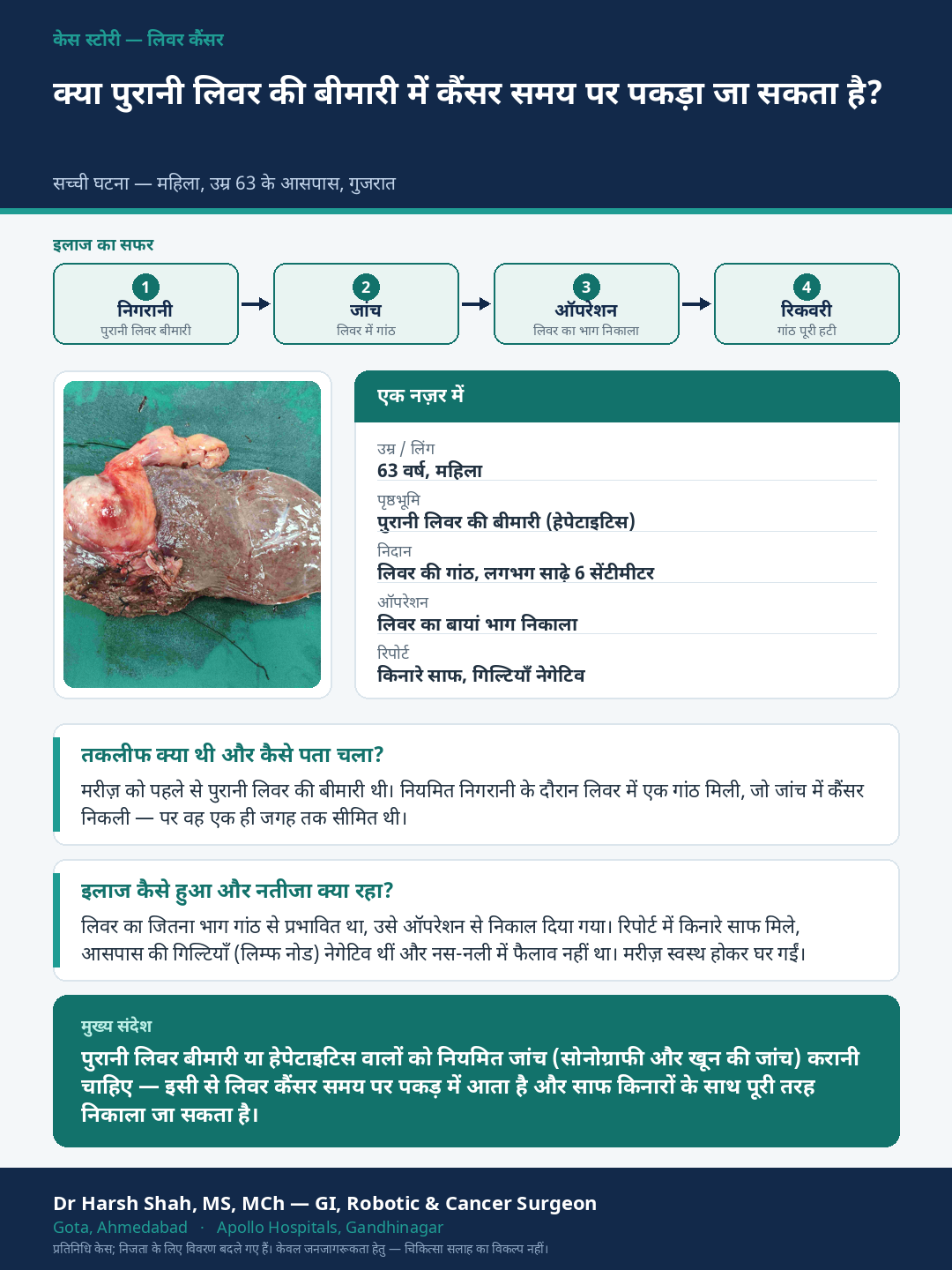 Liver Cancer patient case — Liver cancer caught early on surveillance of chronic liver disease. Dr Harsh Shah, GI & cancer surgeon, Ahmedabad.