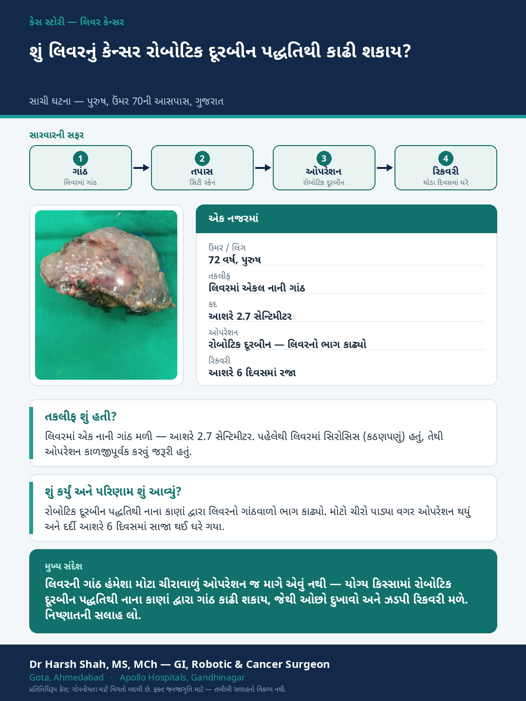 Liver Cancer patient case — Robotic (doorbeen) liver surgery for a small tumour. Dr Harsh Shah, GI & cancer surgeon, Ahmedabad.