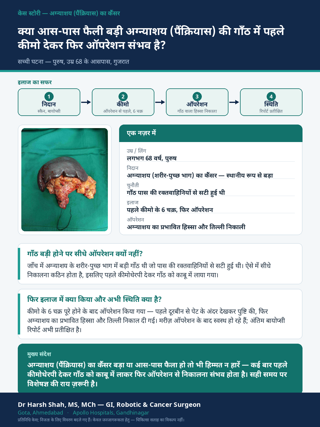 Pancreatic Cancer patient case — A locally advanced tumour brought to surgery with chemotherapy first. Dr Harsh Shah, GI & cancer surgeon, Ahmedabad.