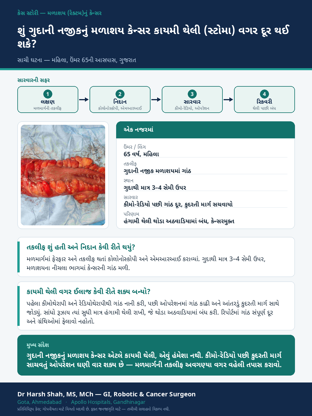 Rectal Cancer patient case — A low rectal cancer treated without a permanent bag. Dr Harsh Shah, GI & cancer surgeon, Ahmedabad.