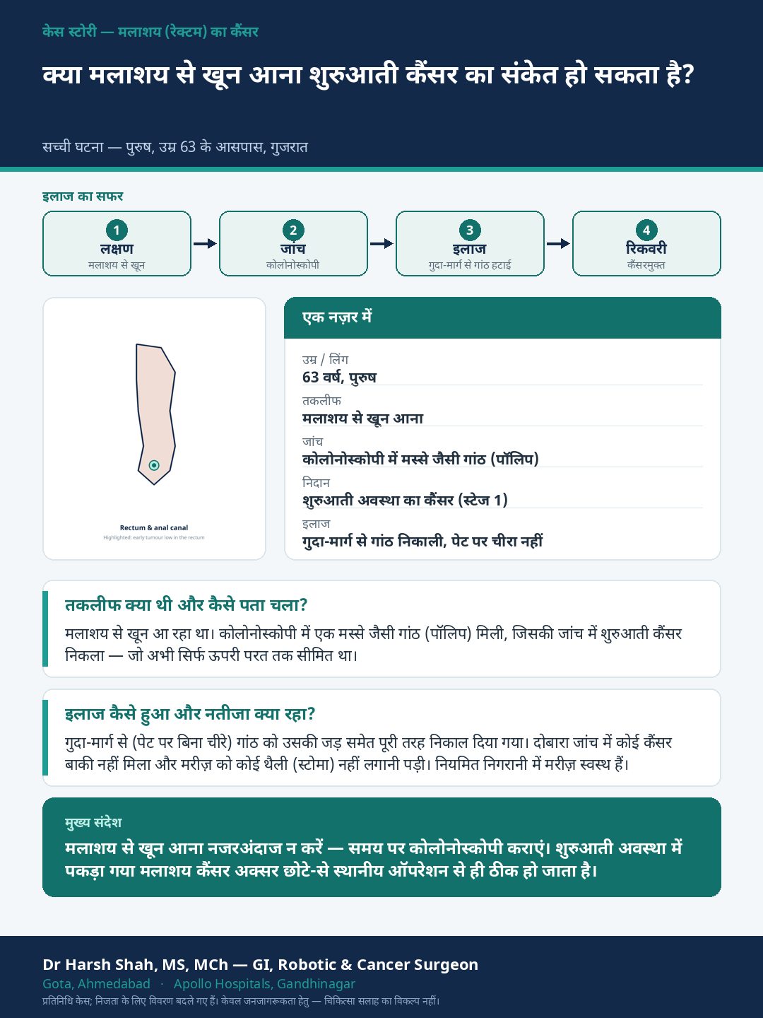 Rectal Cancer patient case — Rectal bleeding that was an early cancer — removed through the anus. Dr Harsh Shah, GI & cancer surgeon, Ahmedabad.