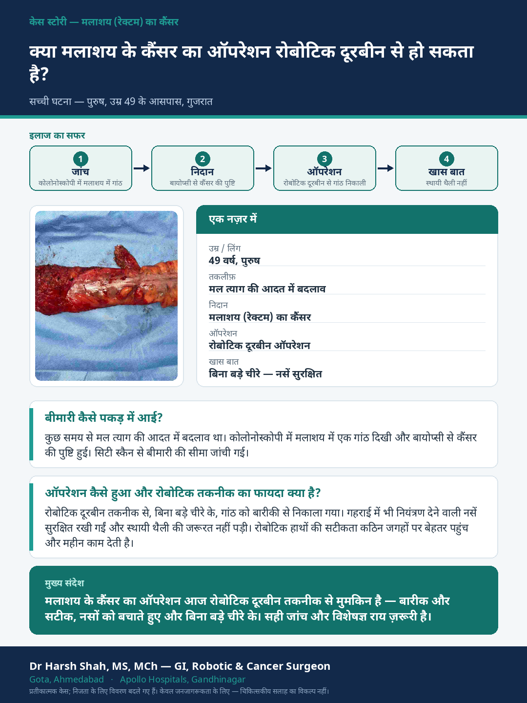 Rectal Cancer patient case — Robotic (doorbeen) surgery for rectal cancer. Dr Harsh Shah, GI & cancer surgeon, Ahmedabad.