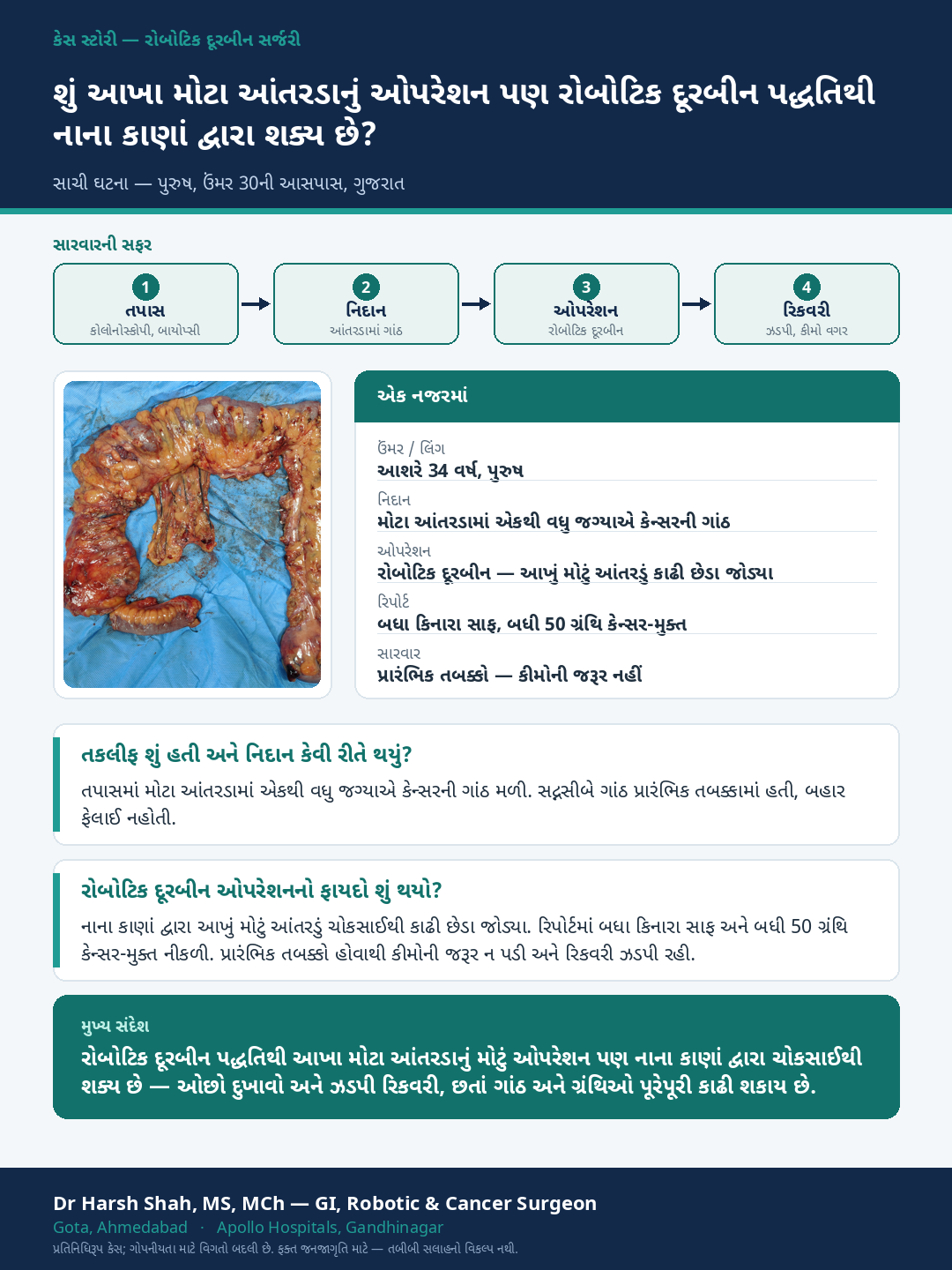 Robotic Cancer Surgery patient case — The whole large intestine removed by robotic (doorbeen) surgery. Dr Harsh Shah, GI & cancer surgeon, Ahmedabad.