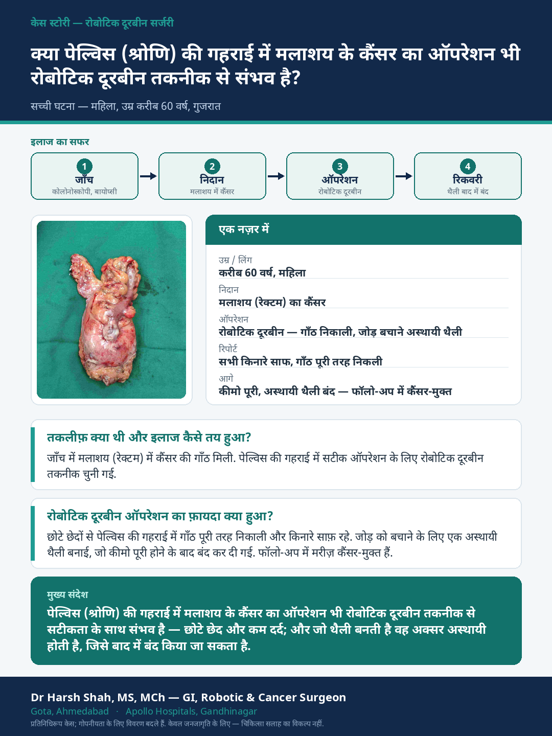 Robotic Cancer Surgery patient case — Robotic precision deep in the pelvis for rectal cancer. Dr Harsh Shah, GI & cancer surgeon, Ahmedabad.