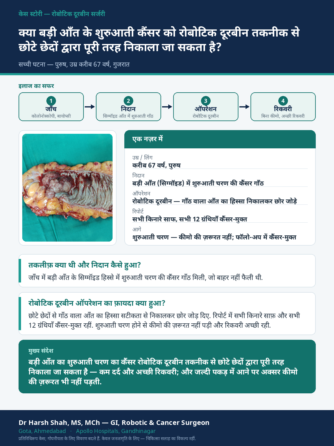Robotic Cancer Surgery patient case — An early colon cancer removed precisely by robotic (doorbeen) surgery. Dr Harsh Shah, GI & cancer surgeon, Ahmedabad.