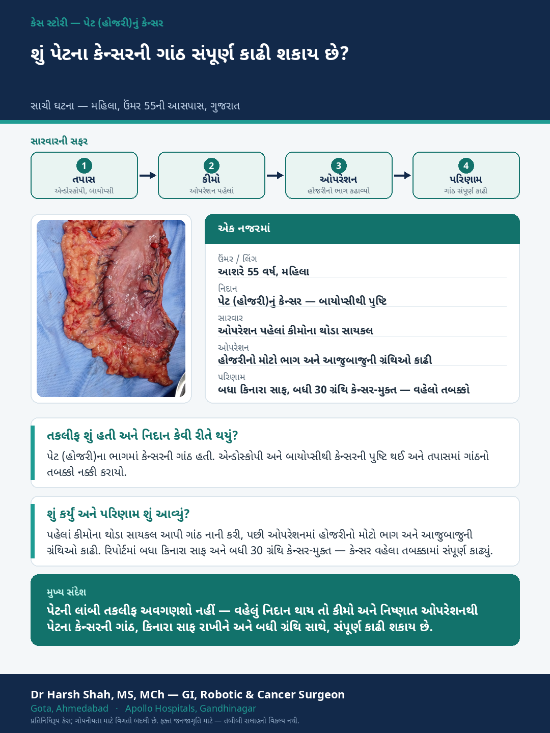 Stomach Cancer patient case — Acting on persistent stomach trouble — complete removal. Dr Harsh Shah, GI & cancer surgeon, Ahmedabad.