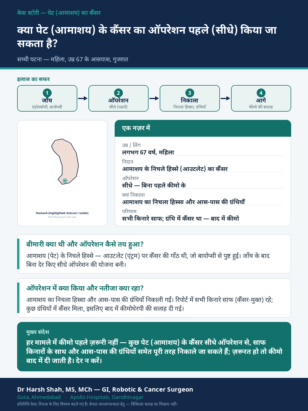 Stomach Cancer patient case — When surgery is done first, with chemotherapy to follow. Dr Harsh Shah, GI & cancer surgeon, Ahmedabad.
