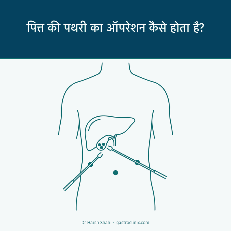 दूरबीन से पित्ताशय की थैली निकालने के छोटे छेद और उपकरण — लिवर के नीचे पित्ताशय