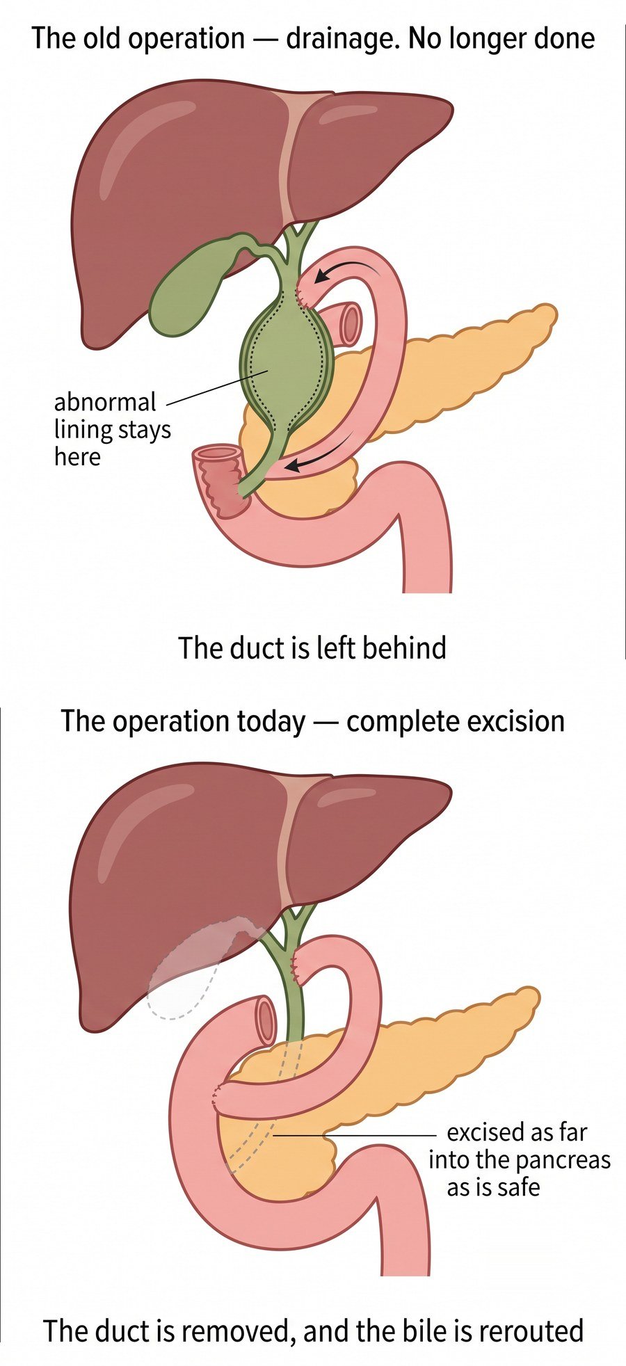 Two diagrams of a choledochal cyst: the old drainage operation leaves the abnormal duct behind; complete excision removes the duct and the bile is rerouted into the bowel.