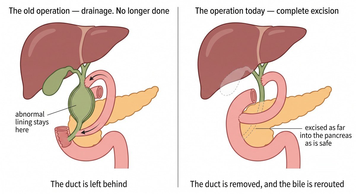 Two diagrams of a choledochal cyst: the old drainage operation leaves the abnormal duct behind; complete excision removes the duct and the bile is rerouted into the bowel.