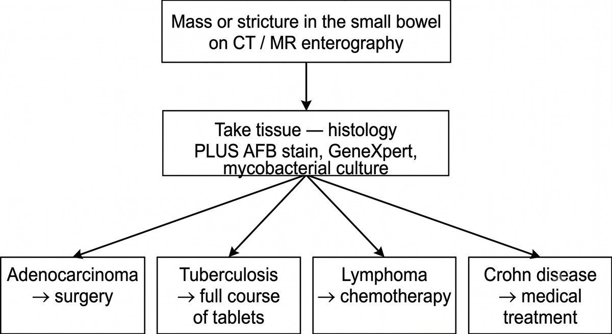 Flowchart: a mass or stricture in the small bowel on CT or MR enterography needs tissue for histology plus AFB stain, GeneXpert and culture, which separates adenocarcinoma, tuberculosis, lymphoma and Crohn disease.