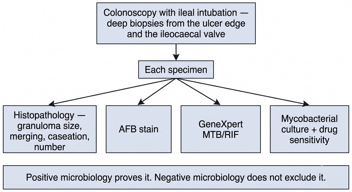 Flowchart: colonoscopy with deep biopsies from the ulcer edge and the ileocaecal valve; each specimen goes for histopathology, AFB stain, GeneXpert and mycobacterial culture. Positive microbiology proves tuberculosis; negative microbiology does not exclude it.